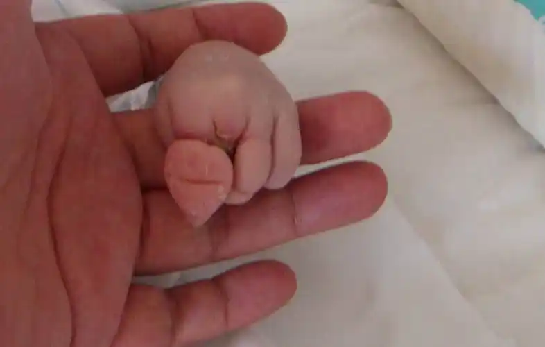 羊膜带导致新生儿左手手指部分畸形