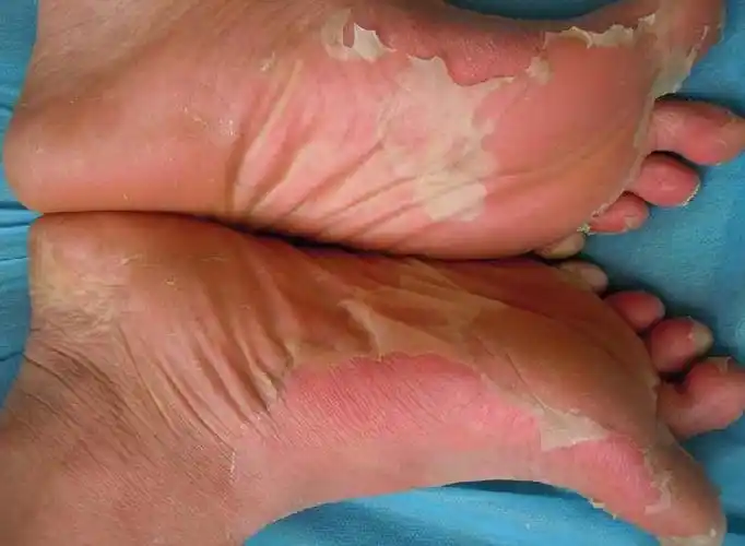 剥脱性皮炎型药疹