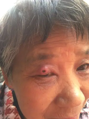 我奶奶的眼睛上长了个脓包,她说不疼不痒,碰到了呢