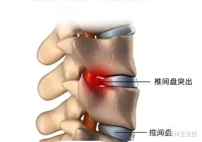脖子僵硬疼痛颈椎病肌肉劳损椎间盘突出有什么区别