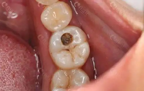 后槽牙烂了个大窟窿疼怎么办拔牙补牙根管治疗哪种有效
