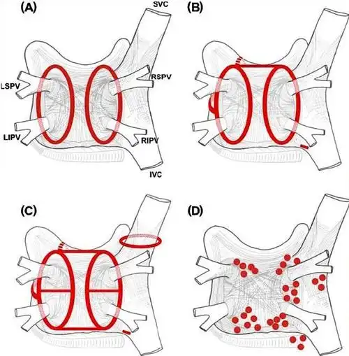 房颤射频消融示意图:隔离肺静脉,从而将"火柴"和"房子"分离开