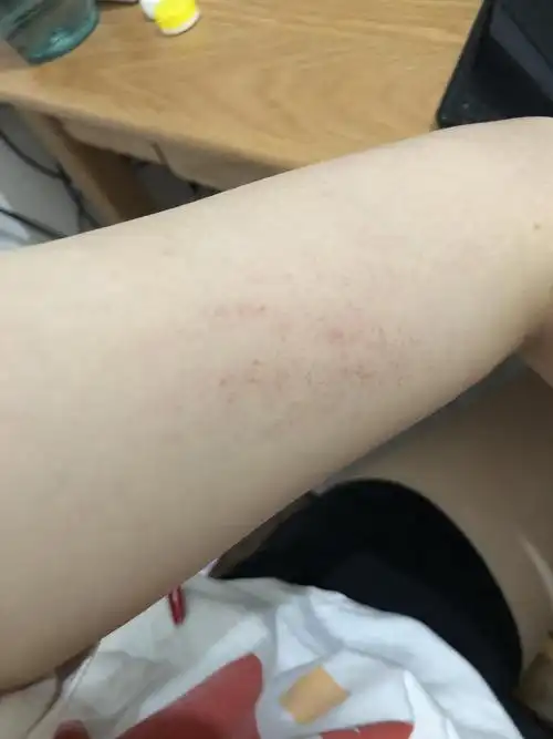 这种莫名其妙的皮下出血是怎么回事啊?有朋友了解吗?