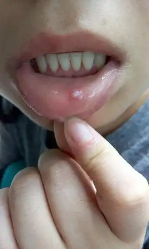 嘴里长个肉,凸起来,不痛,碍事,都半个月了,到底是什么问题,怎么