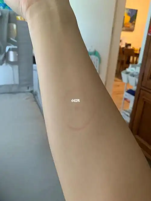 ppd55个小时及检查结果阴性