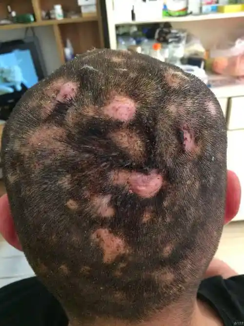 艾滋病患者向伴侣隐瞒艾滋病或追究刑责云南这项新规侵犯隐私权了吗