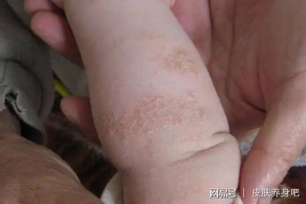 并且这类儿童在婴儿期就出现"尿布牛皮癣",即在用尿布的部位出现暗