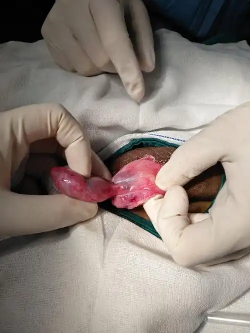 写美篇患者男性,16岁,因"左侧阴囊内容物疼痛6小时"入院住重庆市第九