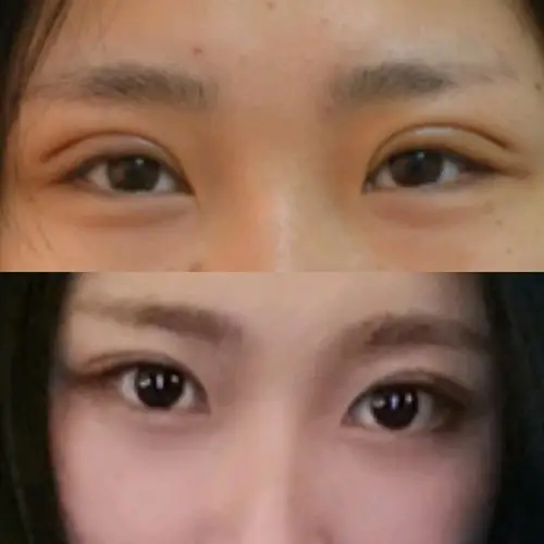 全切开扇双眼皮去皮去脂