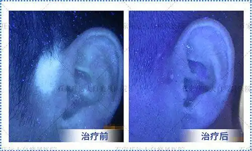 耳朵出现白斑怎么治白斑治疗对比图