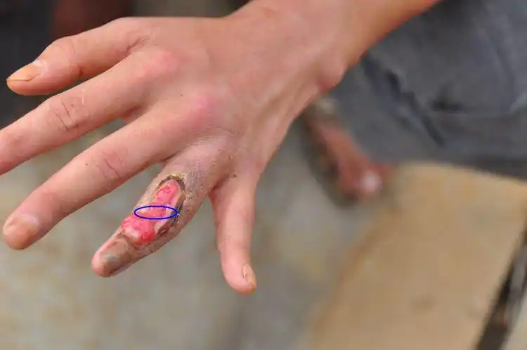 眼镜蛇咬的时候,咬的是伤口的中间位置.