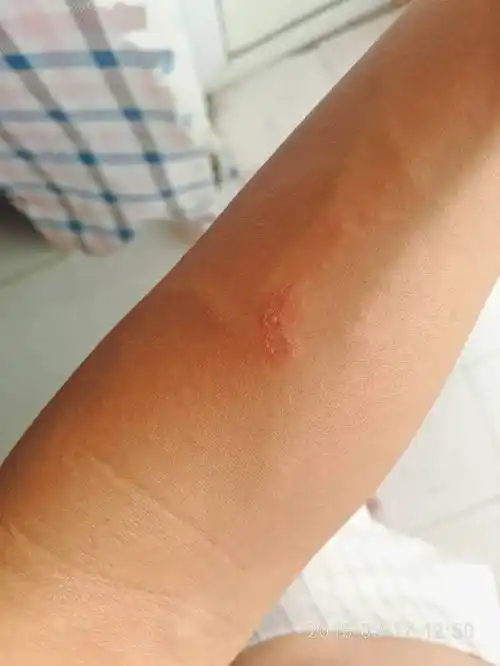 这是什么虫子咬的