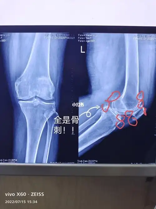 膝关节骨刺处理