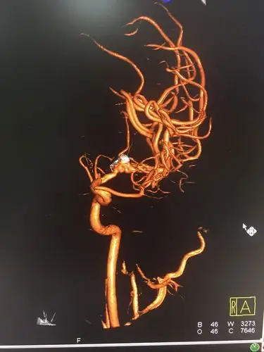 脑血管造影的相关知识