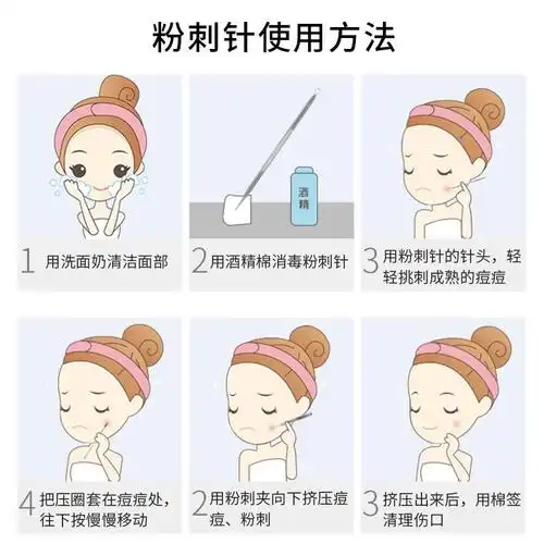 粉刺针套装挑挤粉刺夹挤痘针暗疮针黑头针美容院工具 粉刺5件套 10倍