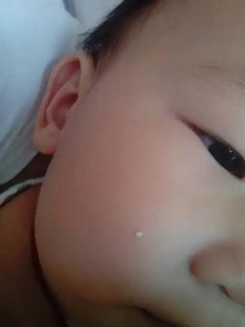 我家小孩脸上长出一个小的白点.照片上的就是,请问是怎么回事?急.