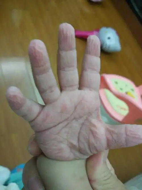 宝贝两岁了,每次洗完澡手就变成这样了,泡的白白的,难道是夏天洗澡