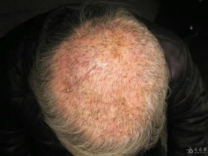 皮肤病头癣一例