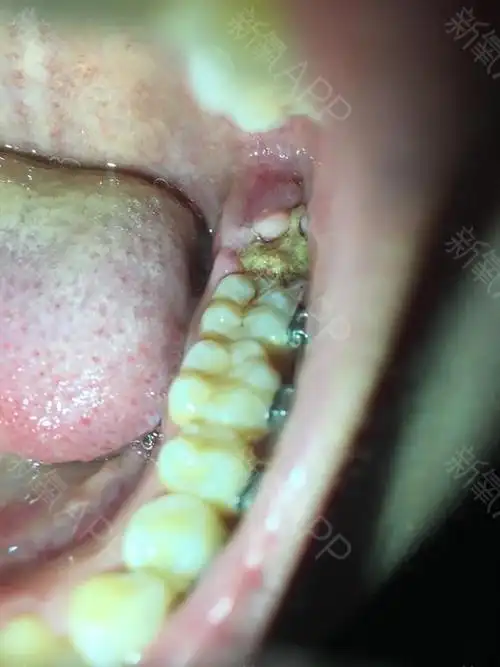 春节的时候智齿发炎了,所以去拔掉,把一侧的上下牙都_圈子-新氧美容