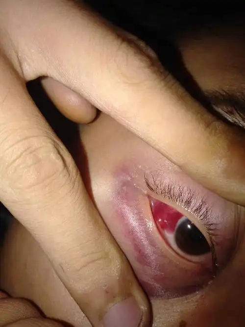 眼睛肿了,眼球也肿了怎么办?