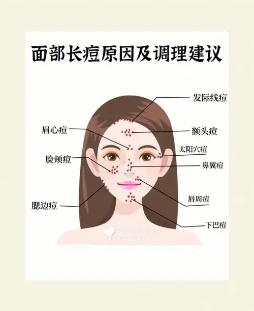 女生面部不同部位长痘的原因