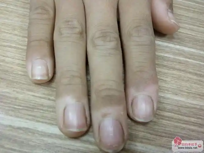 我儿子右手如下图左手五个手指不是很明显是白癜风吗