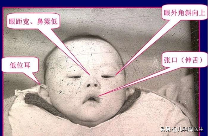 唐氏综合征是什么病(怎么判断宝宝是不是唐氏儿)