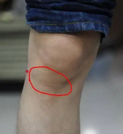 膝盖滑膜增生膝盖滑膜炎的症状表现2022已更新今日动态