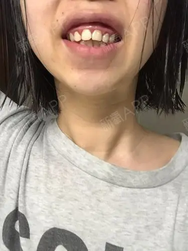 请哪位神医帮我看看我的是骨性的牙齿突出,需要怎么整_圈子-新氧美容