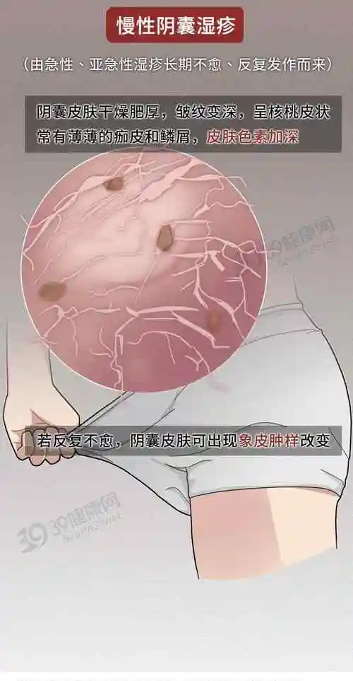 丁丁等处也可能遭殃除了在阴囊的皮肤上发病而是湿疹中常见的一种阴囊