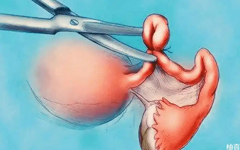 女性做结扎会导致卵巢早衰吗