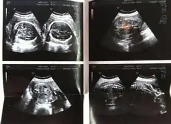 专家谈产前b超检查的局限性不能筛查出所有畸形