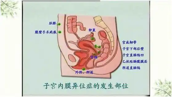 为多见,如卵巢,输卵管,直肠,膀胱等,最常见的就是卵巢子宫内膜异位症