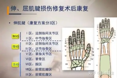 手部肌腱损伤术后康复