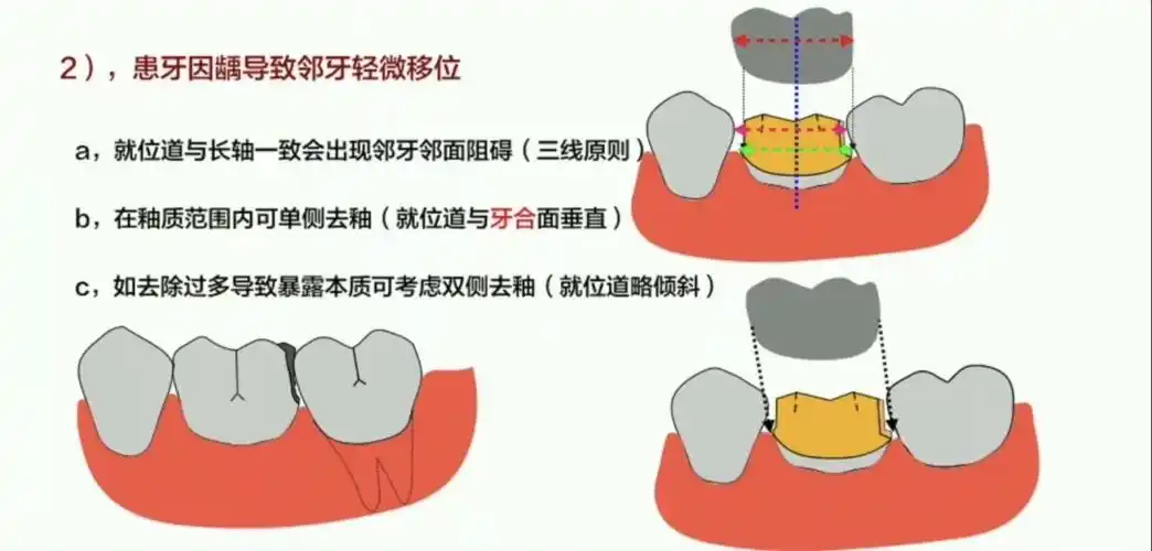 全冠制备肩台的认知 微课 2020.03.30