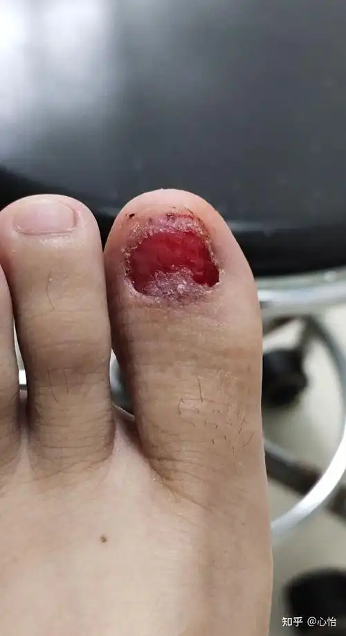 拔大拇指脚指甲