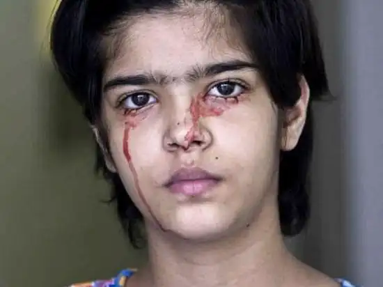 13岁女孩流泪出汗竟是血