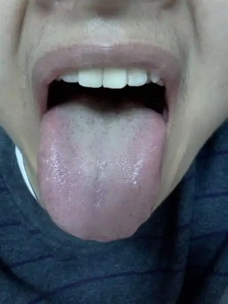 慢性舌炎中药秘方