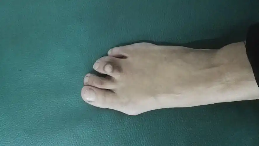 足拇外翻,大脚骨,拇囊炎 - 好大夫在线