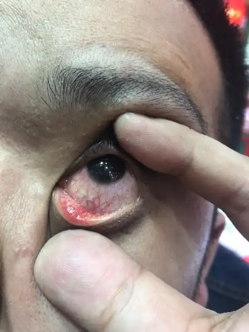 眼球10天前揉红了,滴了一瓶氧氟沙星.