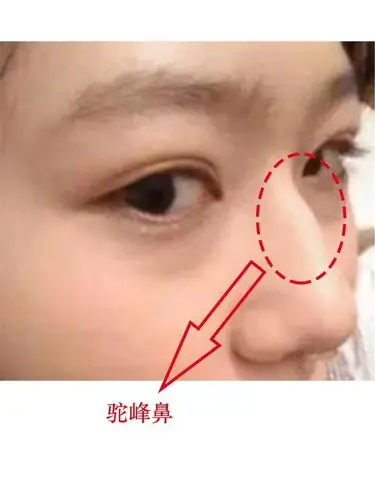 驼峰鼻到底要不要截骨?保留是否一定等于特点?