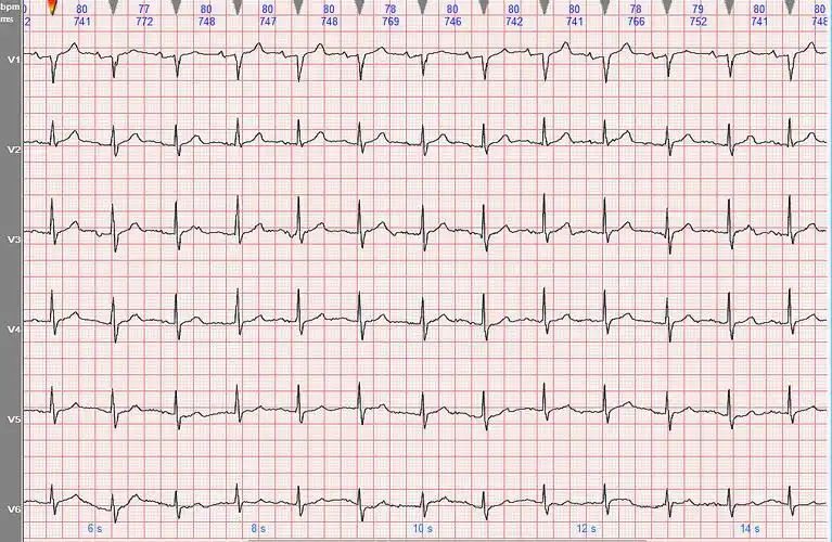 左前分支阻滞心电图特点及分析