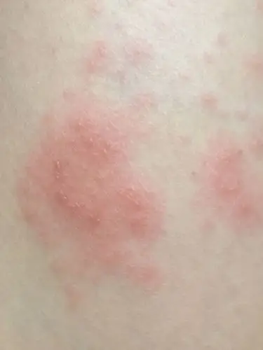 大腿莫名其妙长了这么多小水泡怎么回事,我是孕妇,有药膏可以用吗