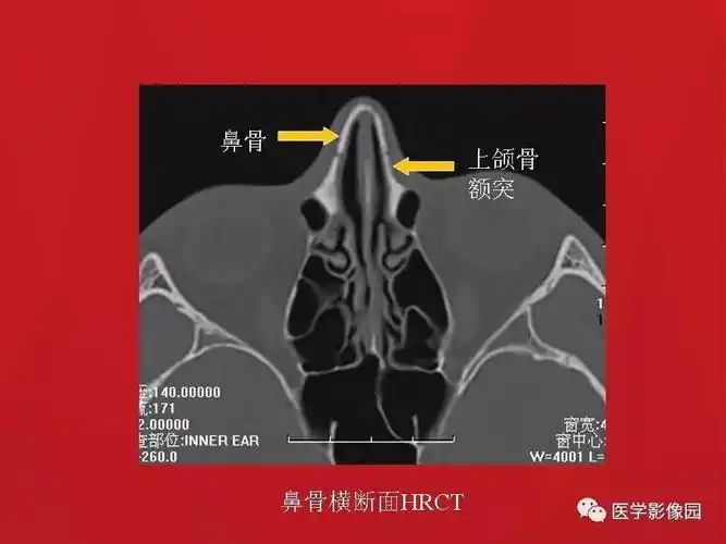 鼻骨骨折影像学诊断与鉴别