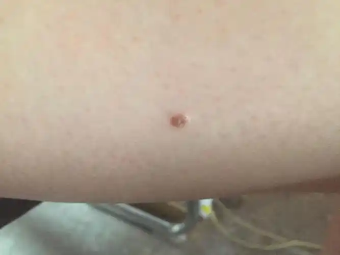 我大腿外侧长了颗痣,慢慢长大了,有事有点痒,请问需要看医生吗?