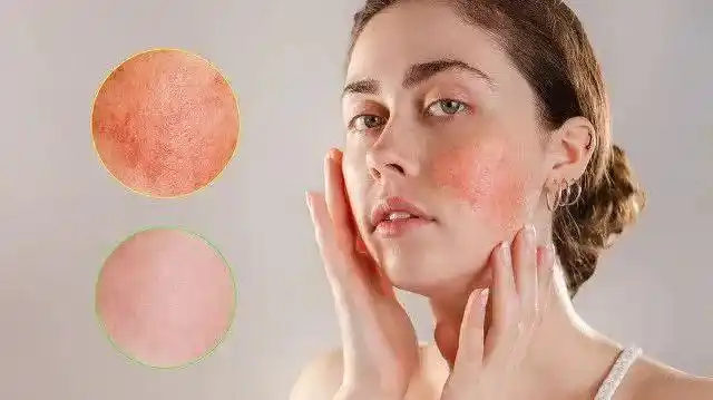 春暖花开时如何预防春敏