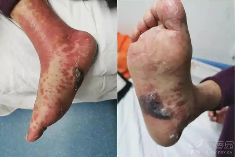 肺癌患者接受帕博利珠单抗治疗后出现的皮疹,是大疱性类天疱疮吗?