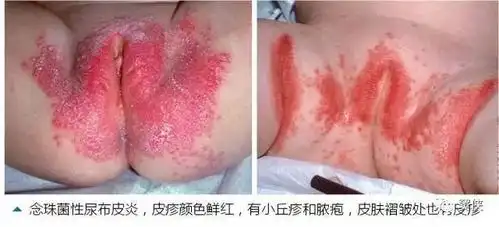 宝宝屁股又红了,怎么办?