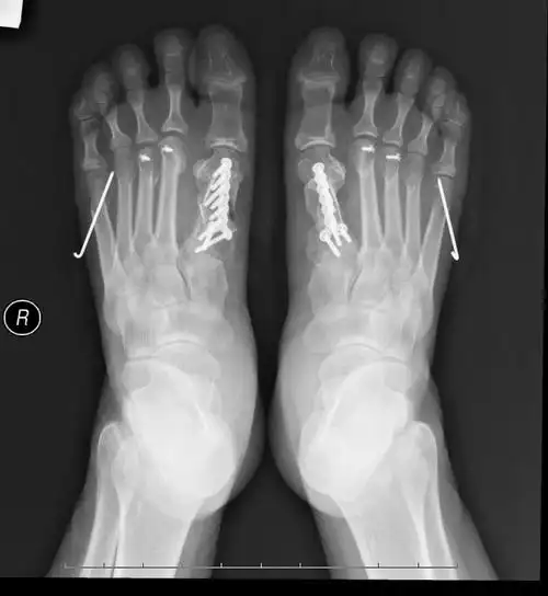 脚趾短小症 - 好大夫在线