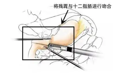 1,毕i式:该吻合方式需要切除远端胃大部,然后将残胃与十二指肠进行